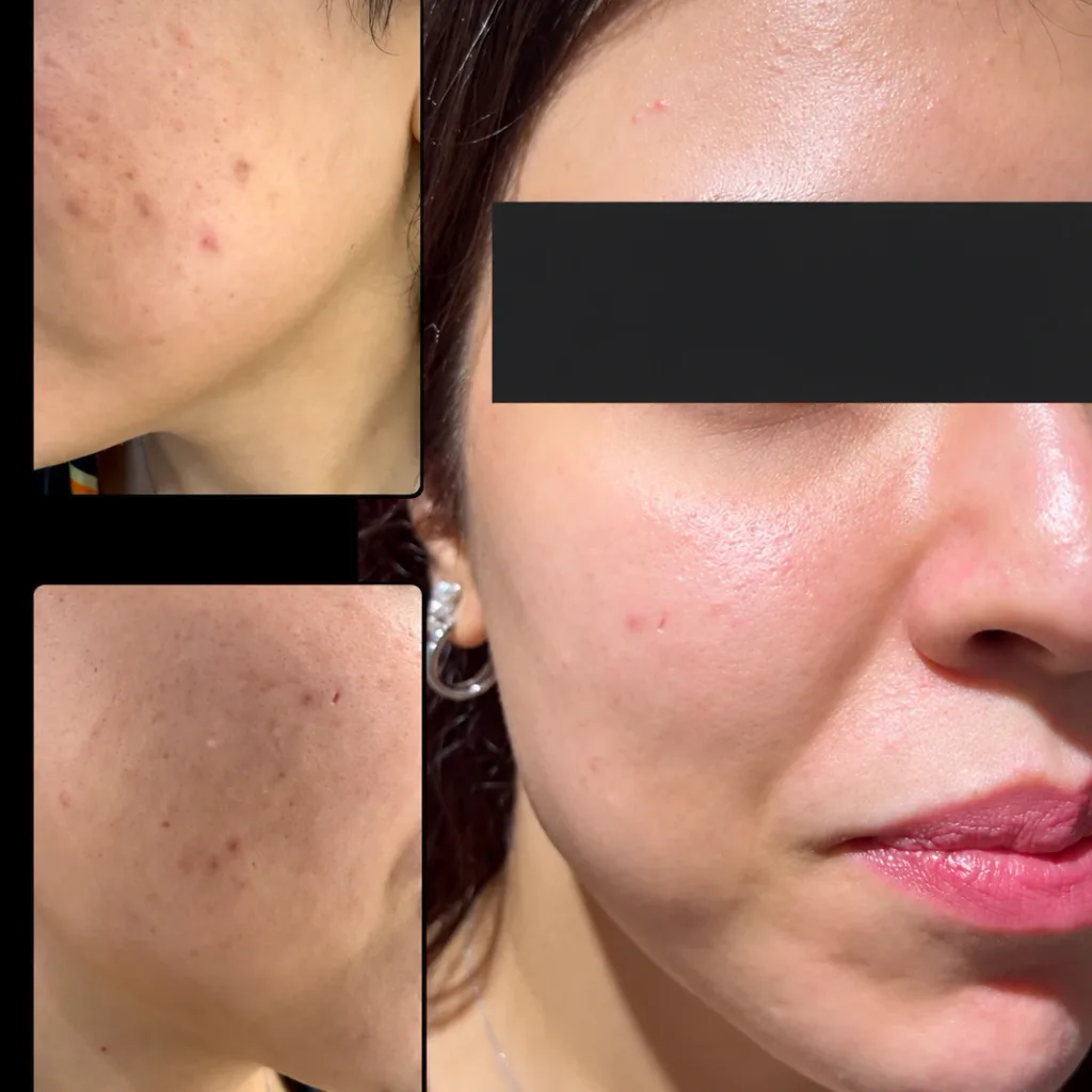 PURE SKIN As Peel Concentre Anti Imperfection 30 ml — photo 3